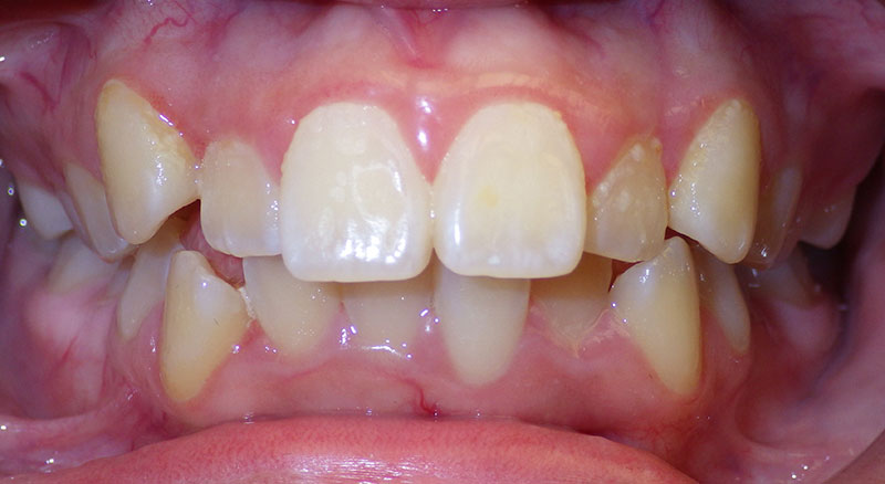 Before After In Honolulu HI Hi Smile Orthodontics